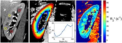 Blood Oxygenation Level-Dependent MRI to Assess Renal Oxygenation in Renal Diseases: Progresses and Challenges